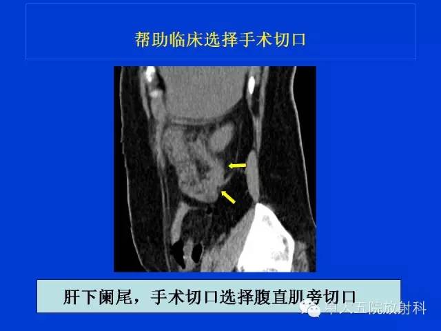 【PPT】正常阑尾和阑尾炎的CT表现