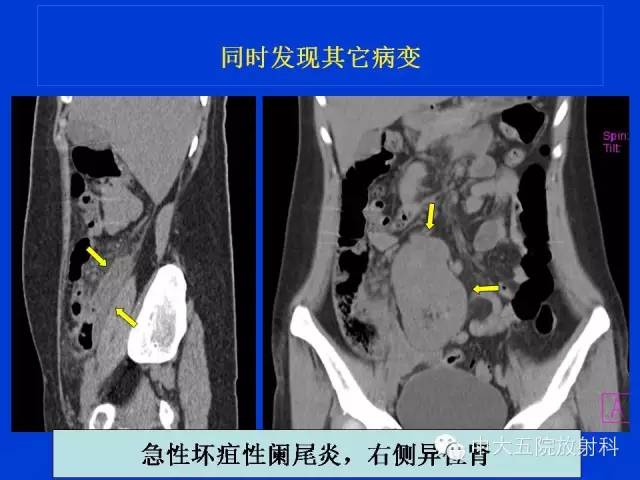 【PPT】正常阑尾和阑尾炎的CT表现
