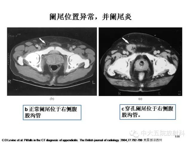 【PPT】正常阑尾和阑尾炎的CT表现