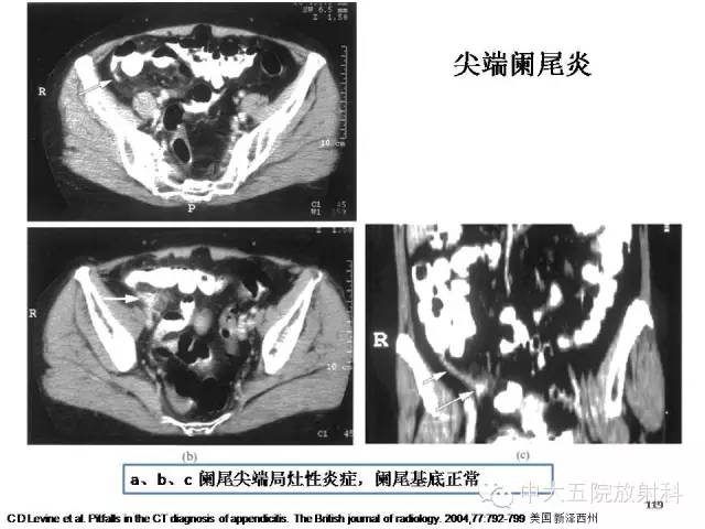 【PPT】正常阑尾和阑尾炎的CT表现