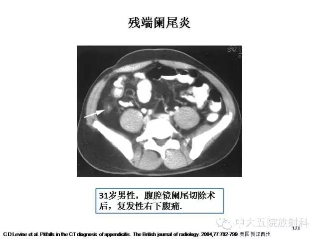 【PPT】正常阑尾和阑尾炎的CT表现