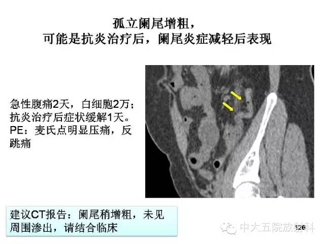 【PPT】正常阑尾和阑尾炎的CT表现