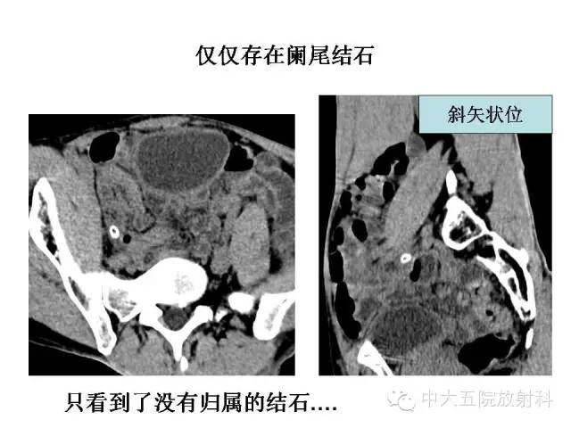 【PPT】正常阑尾和阑尾炎的CT表现