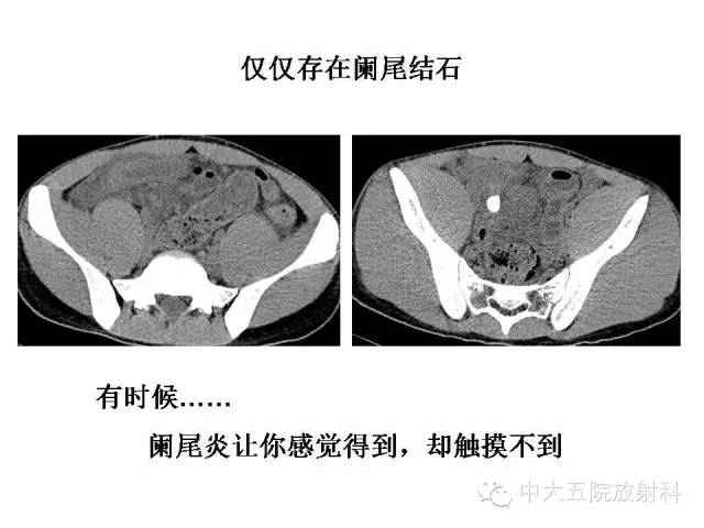 【PPT】正常阑尾和阑尾炎的CT表现