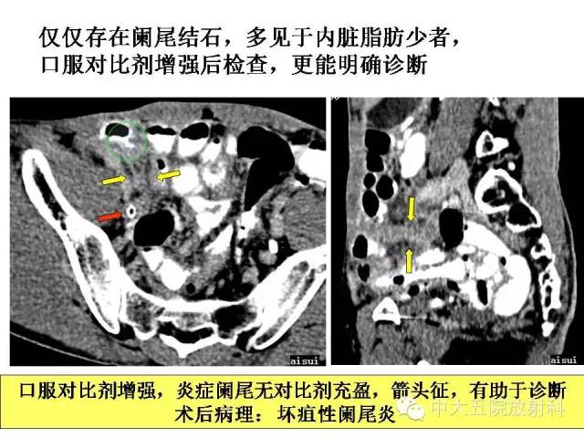 【PPT】正常阑尾和阑尾炎的CT表现