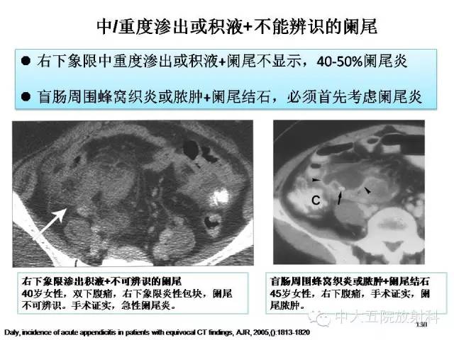 【PPT】正常阑尾和阑尾炎的CT表现