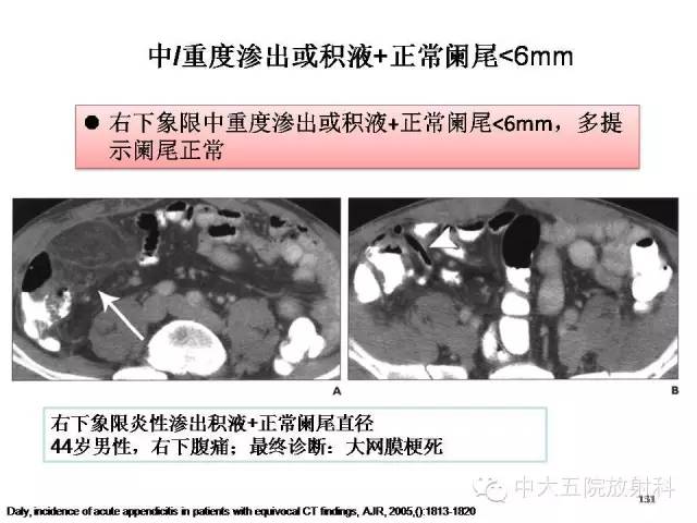 【PPT】正常阑尾和阑尾炎的CT表现