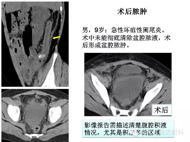 【PPT】正常阑尾和阑尾炎的CT表现