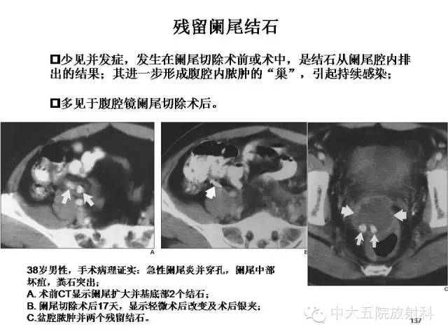 【PPT】正常阑尾和阑尾炎的CT表现
