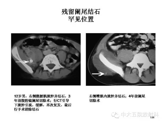【PPT】正常阑尾和阑尾炎的CT表现
