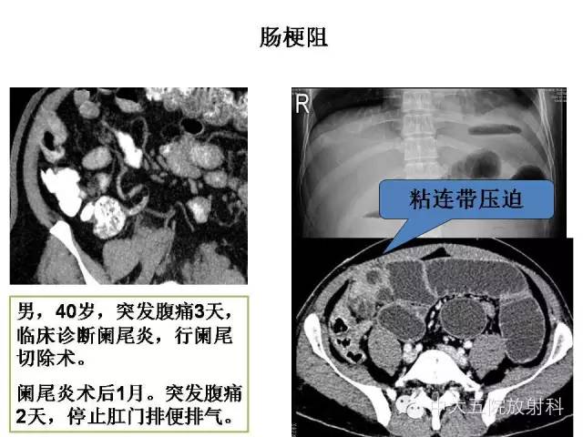 【PPT】正常阑尾和阑尾炎的CT表现