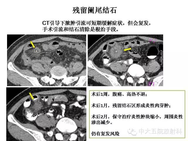 【PPT】正常阑尾和阑尾炎的CT表现