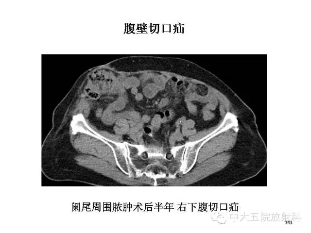 【PPT】正常阑尾和阑尾炎的CT表现
