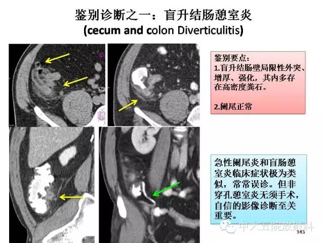 【PPT】正常阑尾和阑尾炎的CT表现