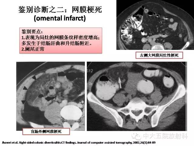 【PPT】正常阑尾和阑尾炎的CT表现