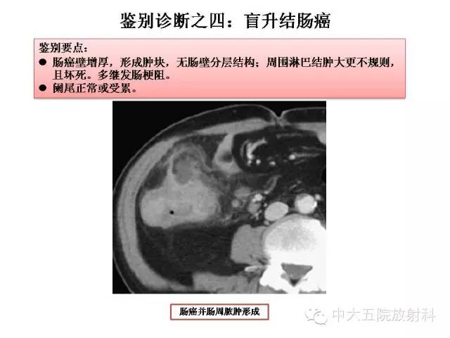 【PPT】正常阑尾和阑尾炎的CT表现
