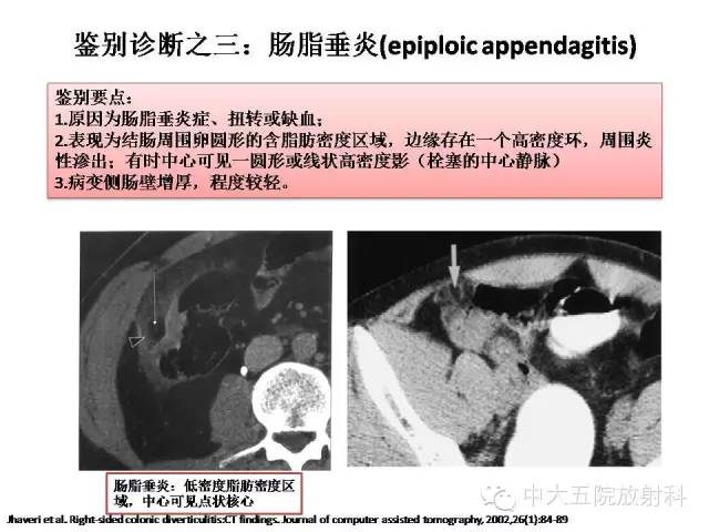 【PPT】正常阑尾和阑尾炎的CT表现