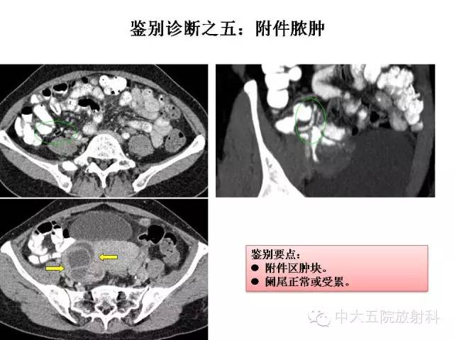 【PPT】正常阑尾和阑尾炎的CT表现