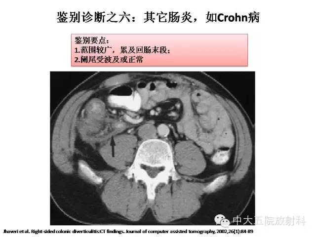 【PPT】正常阑尾和阑尾炎的CT表现