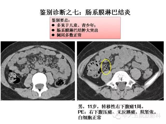 【PPT】正常阑尾和阑尾炎的CT表现