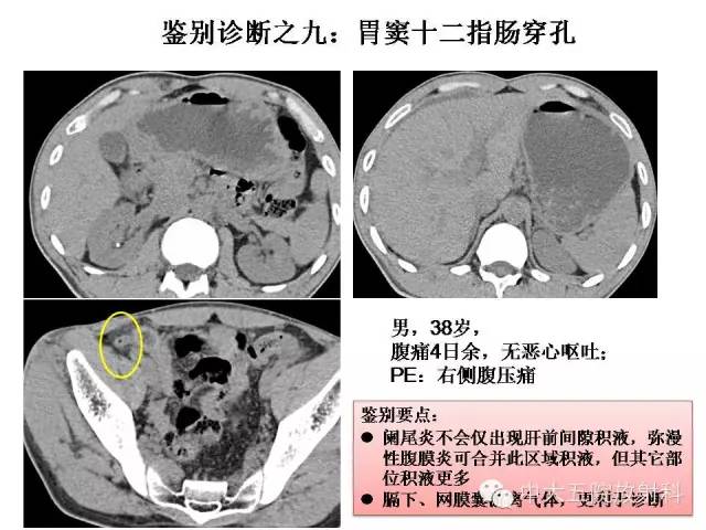 【PPT】正常阑尾和阑尾炎的CT表现