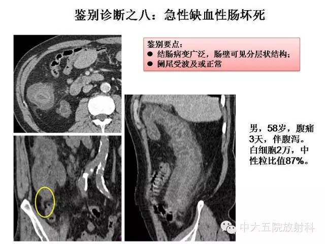 【PPT】正常阑尾和阑尾炎的CT表现
