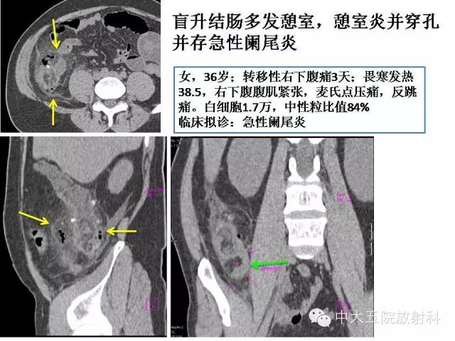 【PPT】正常阑尾和阑尾炎的CT表现