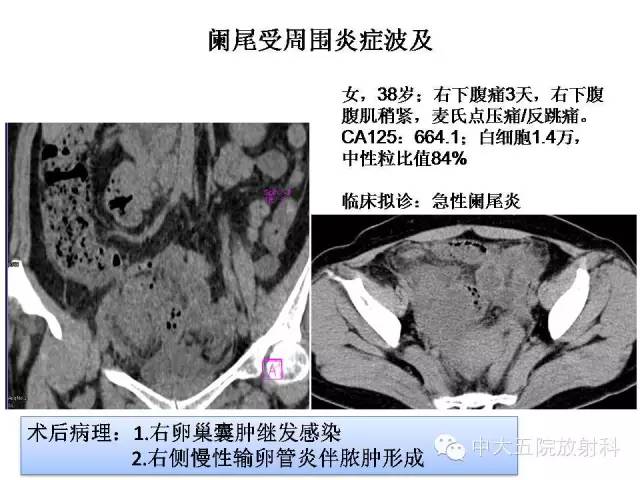 【PPT】正常阑尾和阑尾炎的CT表现