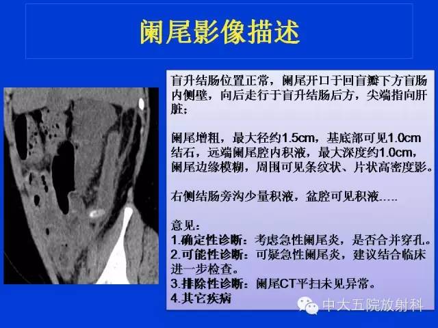 【PPT】正常阑尾和阑尾炎的CT表现