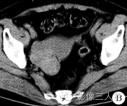 【病例】双侧卵巢Brenner瘤1例CT影像分析 【病例】双侧卵巢Brenner瘤1例CT影像分析
