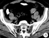 【病例】双侧卵巢Brenner瘤1例CT影像分析 【病例】双侧卵巢Brenner瘤1例CT影像分析