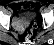 【病例】双侧卵巢Brenner瘤1例CT影像分析