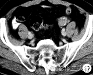 【病例】双侧卵巢Brenner瘤1例CT影像分析 【病例】双侧卵巢Brenner瘤1例CT影像分析