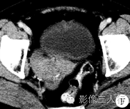 【病例】双侧卵巢Brenner瘤1例CT影像分析 【病例】双侧卵巢Brenner瘤1例CT影像分析