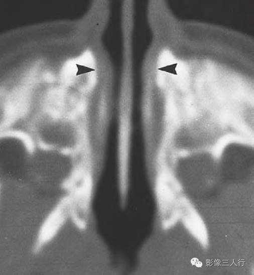 【病例】先天性鼻梨状孔狭窄1例CT影像表现 【病例】先天性鼻梨状孔狭窄1例CT影像表现