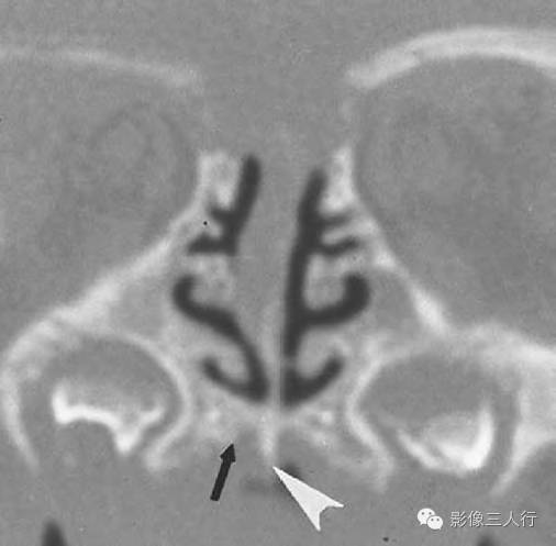【病例】先天性鼻梨状孔狭窄1例CT影像表现 【病例】先天性鼻梨状孔狭窄1例CT影像表现