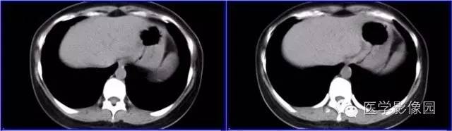 【病例】胰体尾部实性假乳头状瘤1例CT影像表现与鉴别 【病例】胰体尾部实性假乳头状瘤1例CT影像表现与鉴别