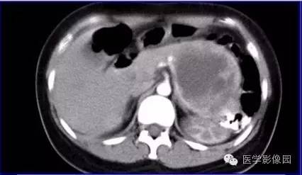 【病例】胰体尾部实性假乳头状瘤1例CT影像表现与鉴别 【病例】胰体尾部实性假乳头状瘤1例CT影像表现与鉴别