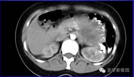 【病例】胰体尾部实性假乳头状瘤1例CT影像表现与鉴别 【病例】胰体尾部实性假乳头状瘤1例CT影像表现与鉴别