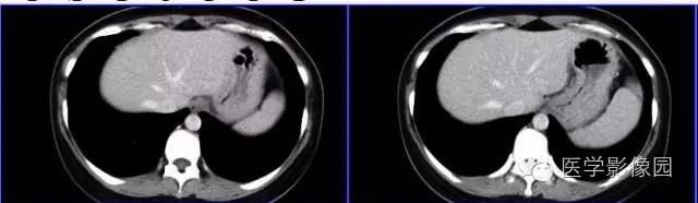 【病例】胰体尾部实性假乳头状瘤1例CT影像表现与鉴别 【病例】胰体尾部实性假乳头状瘤1例CT影像表现与鉴别