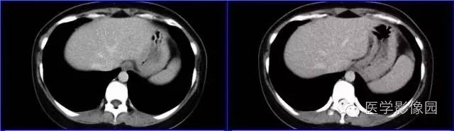 【病例】胰体尾部实性假乳头状瘤1例CT影像表现与鉴别 【病例】胰体尾部实性假乳头状瘤1例CT影像表现与鉴别