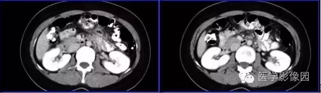 【病例】胰体尾部实性假乳头状瘤1例CT影像表现与鉴别 【病例】胰体尾部实性假乳头状瘤1例CT影像表现与鉴别