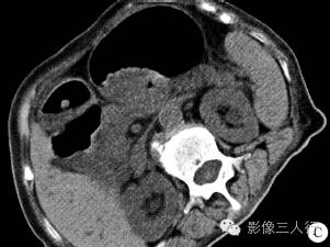 【病例】胃底大弯及幽门部腺瘤样息肉1例CT影像表现分析 【病例】胃底大弯及幽门部腺瘤样息肉1例CT影像表现分析