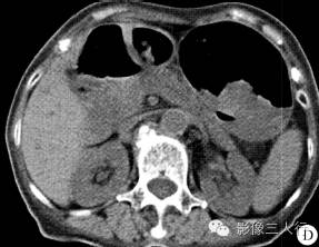 【病例】胃底大弯及幽门部腺瘤样息肉1例CT影像表现分析 【病例】胃底大弯及幽门部腺瘤样息肉1例CT影像表现分析
