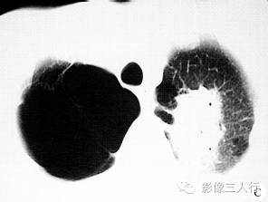 【病例】左肺上叶炎性肌纤维母细胞瘤1例X线CT影像分析