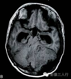 【病例】神经母细胞瘤1例CT及MR影像表现分析