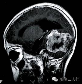 【病例】神经母细胞瘤1例CT及MR影像表现分析