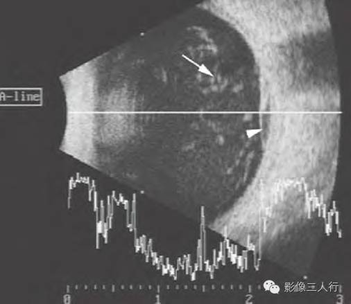 【病例】出血性视网膜脱离1例MR影像表现 【病例】出血性视网膜脱离1例MR影像表现