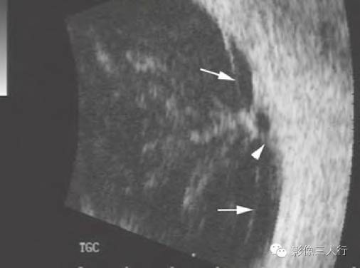 【病例】出血性视网膜脱离1例MR影像表现 【病例】出血性视网膜脱离1例MR影像表现