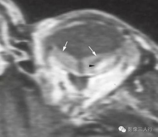【病例】出血性视网膜脱离1例MR影像表现